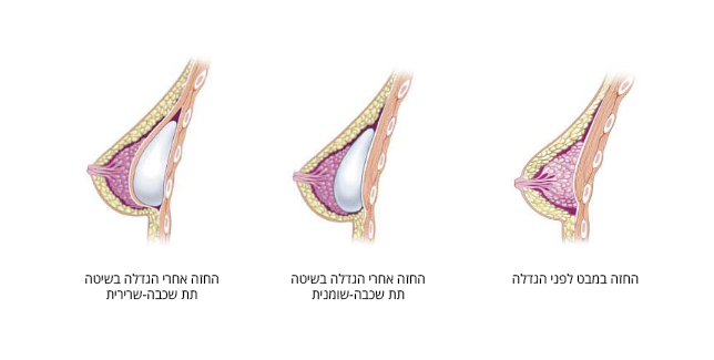 תרשים שיטות להגדלת חזה